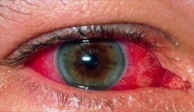 uveite, infiammazione tunica media vascolare dell'occhio